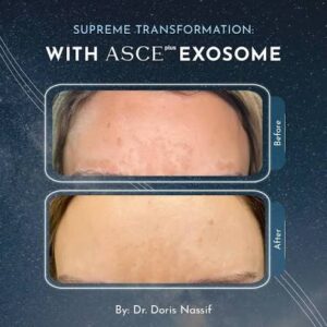 Микронидлинг с екзозоми за лице и коса | ASCEplus®