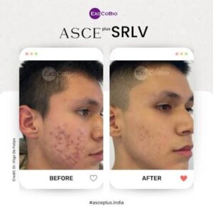 Микронидлинг с екзозоми за лице и коса | ASCEplus®