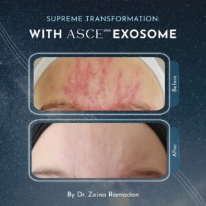 Микронидлинг с екзозоми за лице и коса | ASCEplus®