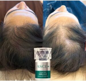 Микронидлинг с екзозоми за лице и коса | ASCEplus®